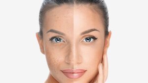 Chemical Peels Aftercare