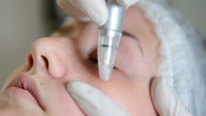 Microdermabrasion Aftercare Advice