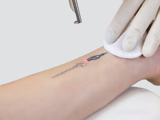 tattoo removal cAT